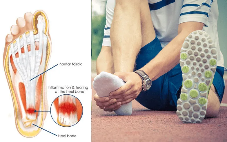 Foot Arch Support Compression Straps